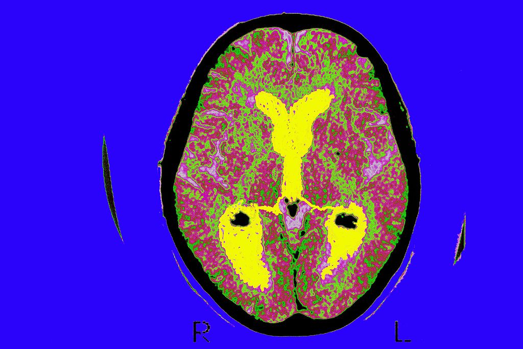 AlzheimerS Disease, Scan - Startlap