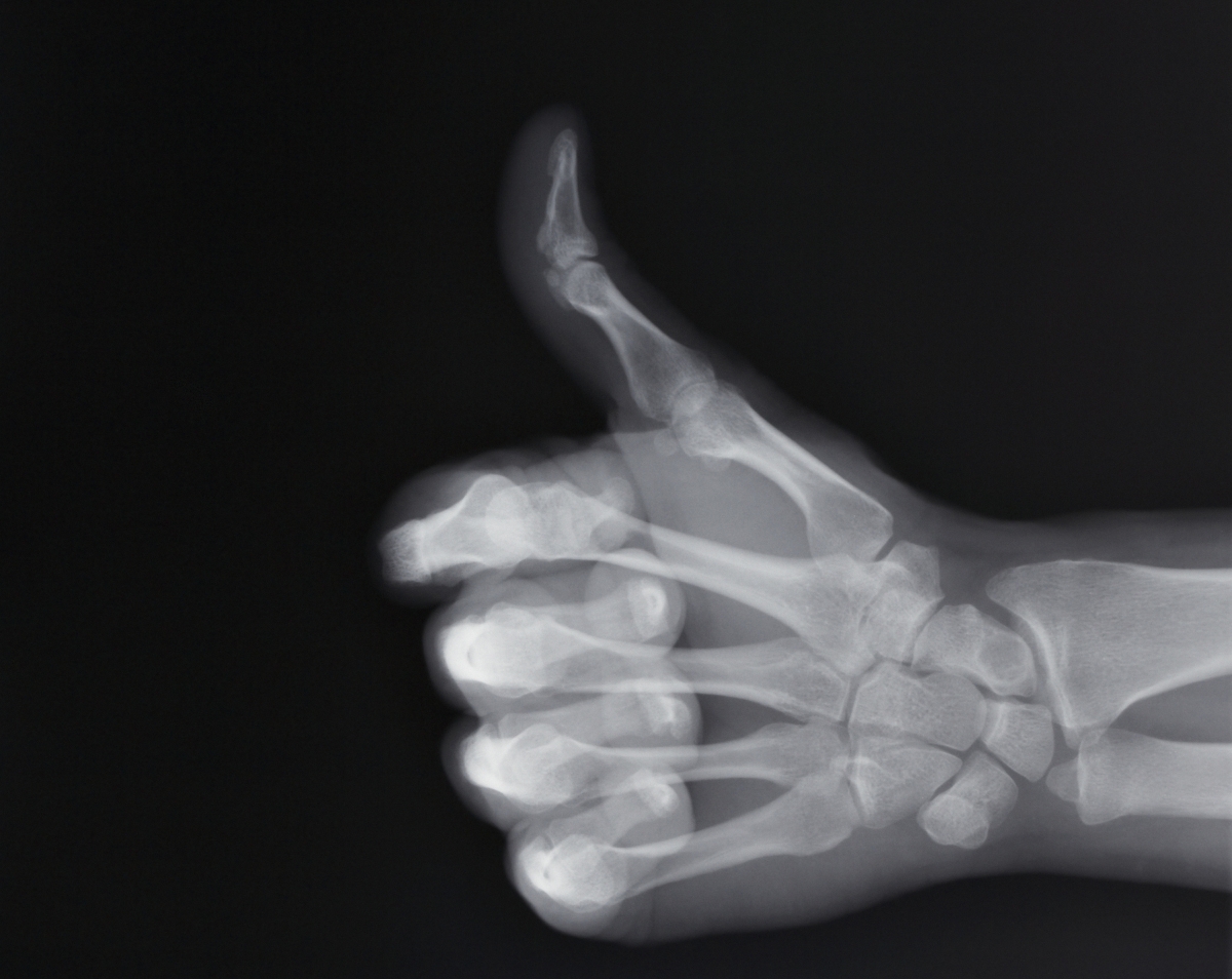 egy emberi kéz röntgenképe